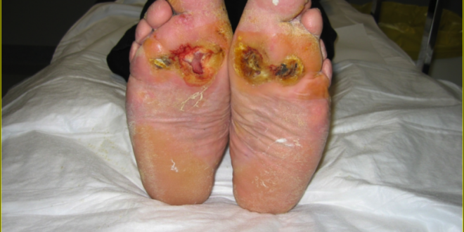 piede diabetico