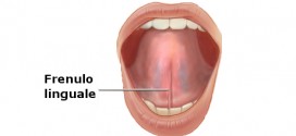 frenulo_linguale_anchiloglossia