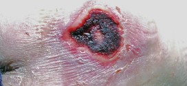 ulcera-coccigea