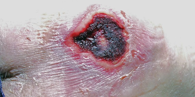 ulcera-coccigea