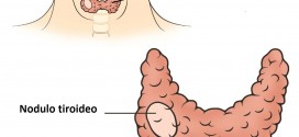 Nodulo-tiroideo