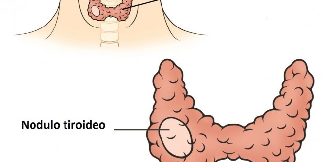 Nodulo-tiroideo