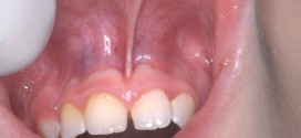 tumori-cavo-orale