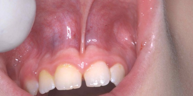 tumori-cavo-orale
