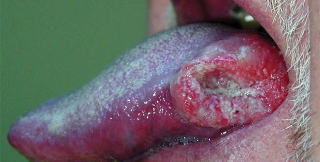 carcinoma-orale
